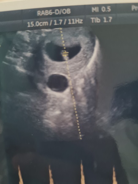 Private scan revealed cyst?