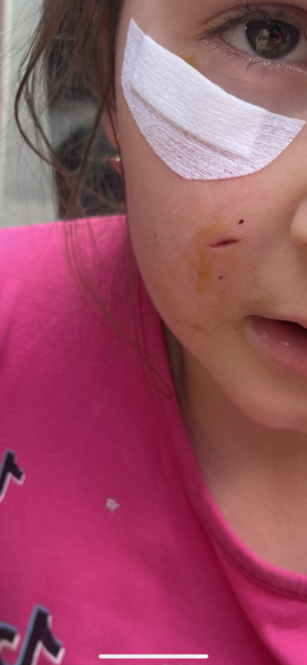 Dog bite