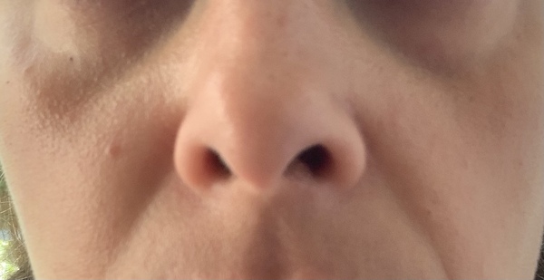 What can I do about these under eye bags and nose lines?