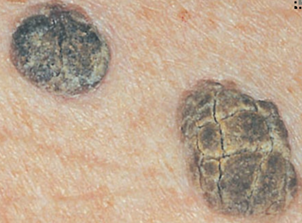 Does this look like a seborrheic keratosis?