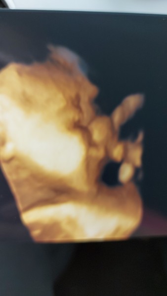 Potential nose growth 3d ultrasound