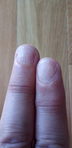 What is going on with my fingernails?