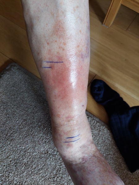 Cellulitis ?