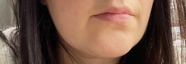 How to reduce or get rid of the beginning appearance of jowels?