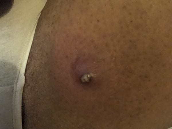 Abscess (pic), should I pop it?