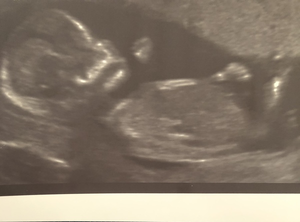 Due March / April 2022 2nd thread 2nd trimester