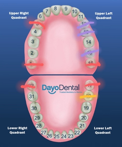 To want to get dentures?