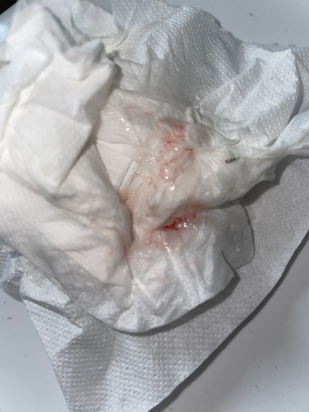 Bv treatment now bleeding