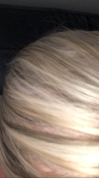 Bald spots