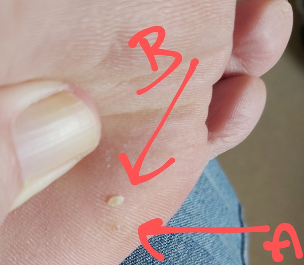 Painful sugar like 'crystals' under skin in Feet ?