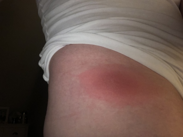 Tick bite - do I have Lymes Disease?