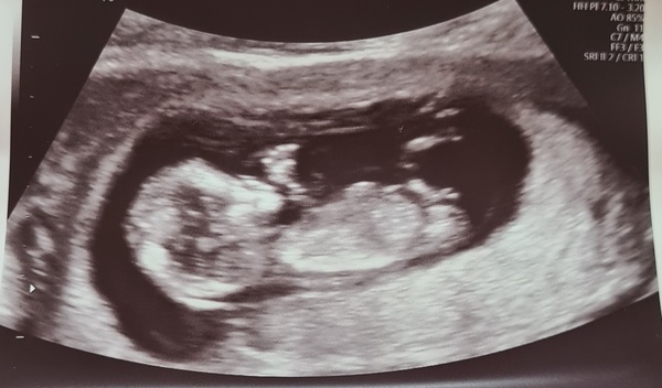 Due March / April 2022 2nd thread 2nd trimester