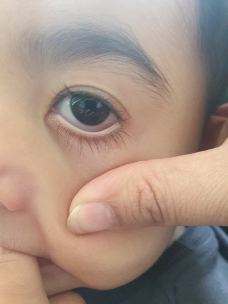 1 year old 1 eye is red