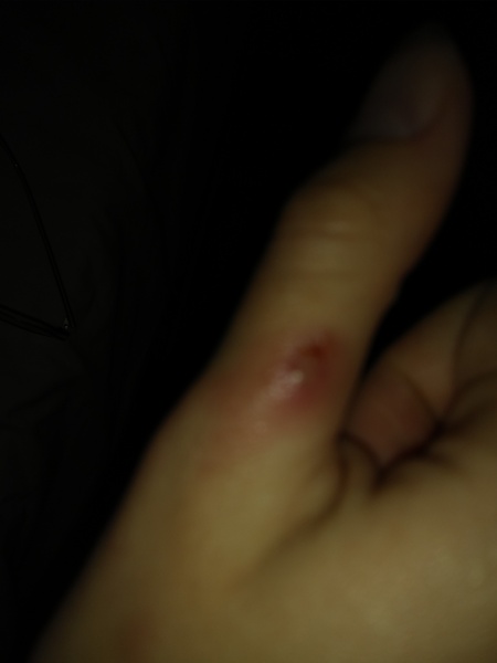 Infected blister