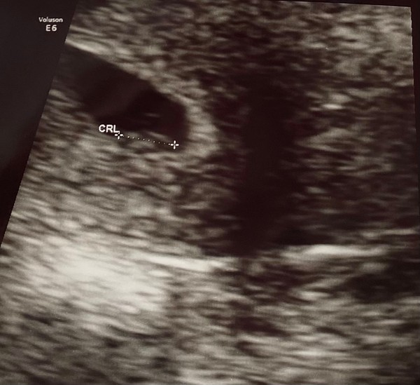 Anyone else 5 weeks pregnant?