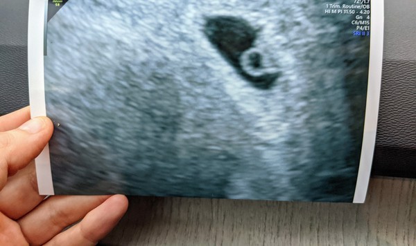 Anyone else 5 weeks pregnant?