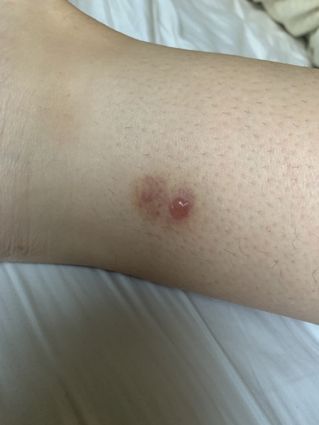 To ask you WTF bit me?!