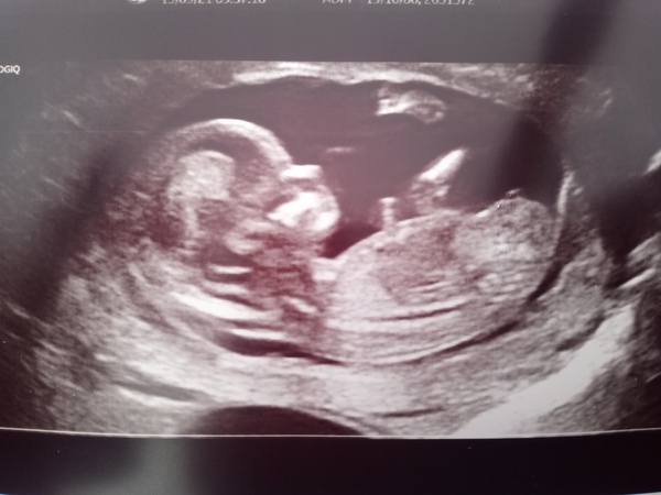 Due March / April 2022 2nd thread 2nd trimester