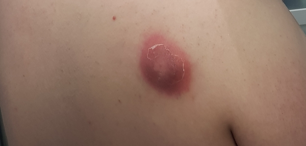 Havent been able to see a GP, bit concerned, bit gross now...
