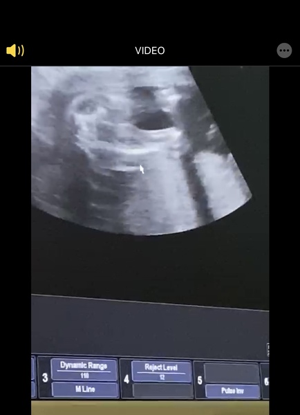 Femur/Potty Shot at 21 weeks