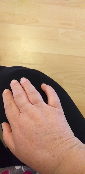 Feeling tired, odema, put in a stone in a month, breathless. Gp insists I am fine.