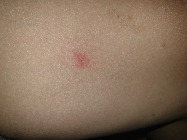 Help me figure out what's biting me please