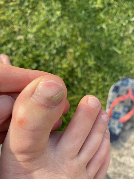 Anyone a nurse or chiropodist?  Or ever lost a toenail?