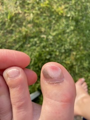 Anyone a nurse or chiropodist?  Or ever lost a toenail?