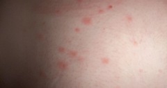 A rash has developed.