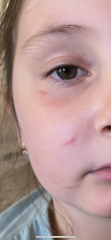 Dog bite