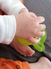 Toddler rash