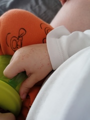 Toddler rash
