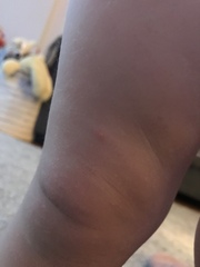 Could this be Chickenpox?