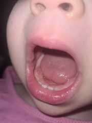 Teething- swollen gum pics attached