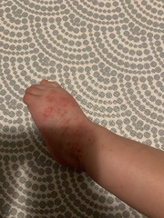 Does this look like early stages of chickenpox or something else?