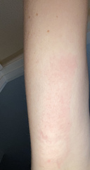 Insect sting