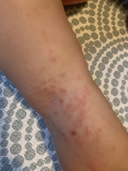 Does this look like early stages of chickenpox or something else?