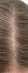 Androgenic alopecia?
