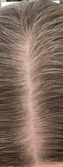 Androgenic alopecia?