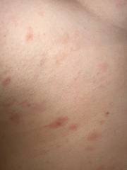 A rash has developed.