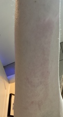 Insect sting