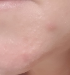 What type of facial is good for spot prone skin?