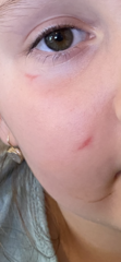 Dog bite