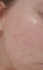 What type of facial is good for spot prone skin?