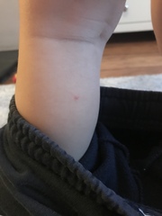 Could this be Chickenpox?