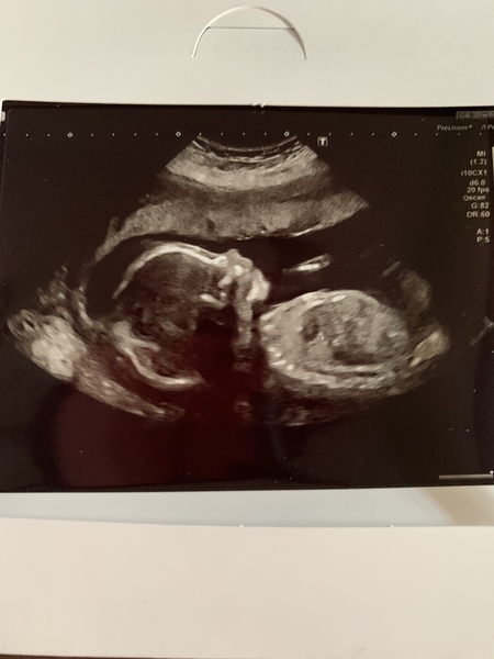 11 days late -BFN! Please someone give me a success story.