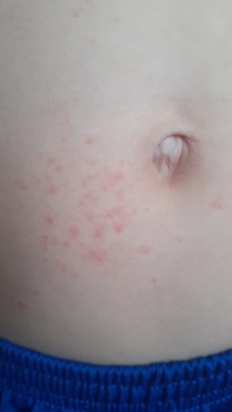 Measles?