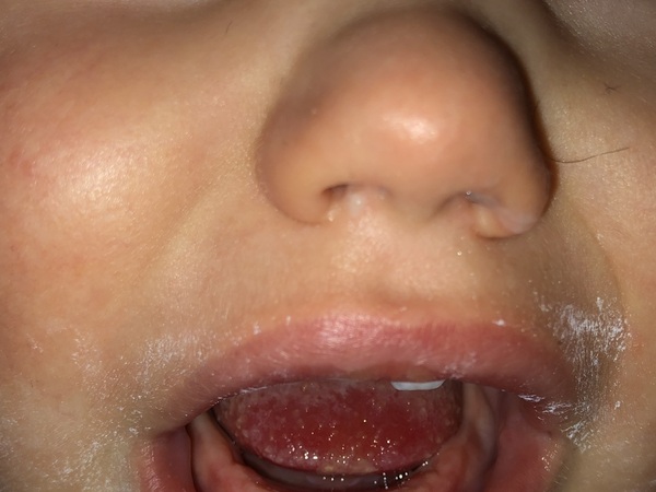 White patches in 1yr olds mouth