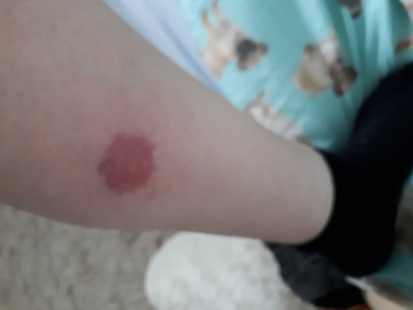 Ringworm/psoriasis/Lyme Disease? WARNING PIC ATTACHED