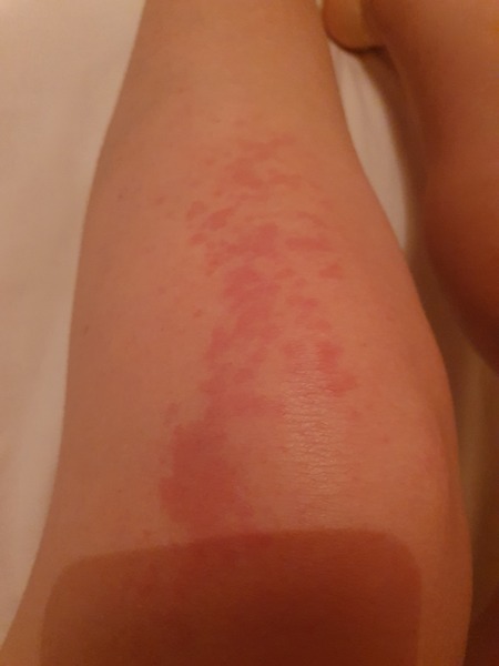 Itchy and now rash at 7 weeks